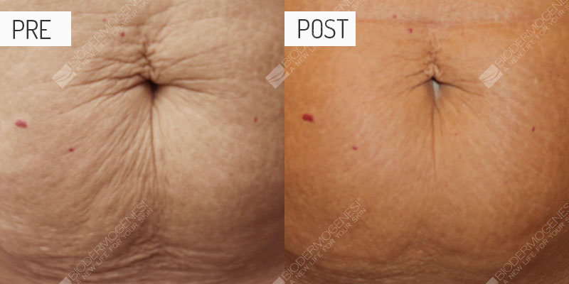 Celulitis y flacidez: fotos de antes y después
