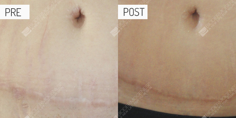 Cicatrices: fotos de antes y después