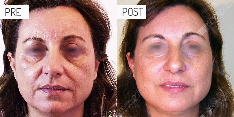 Rejuvenecimiento facial: fotos de antes y después